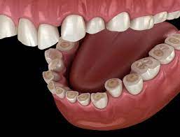 Bruxism or teeth clenching is a common problem whi... main image