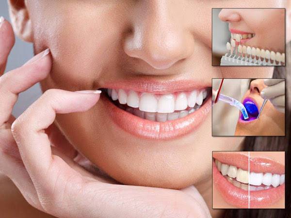 Smile makeover is a cosmetic dental procedure t... main image