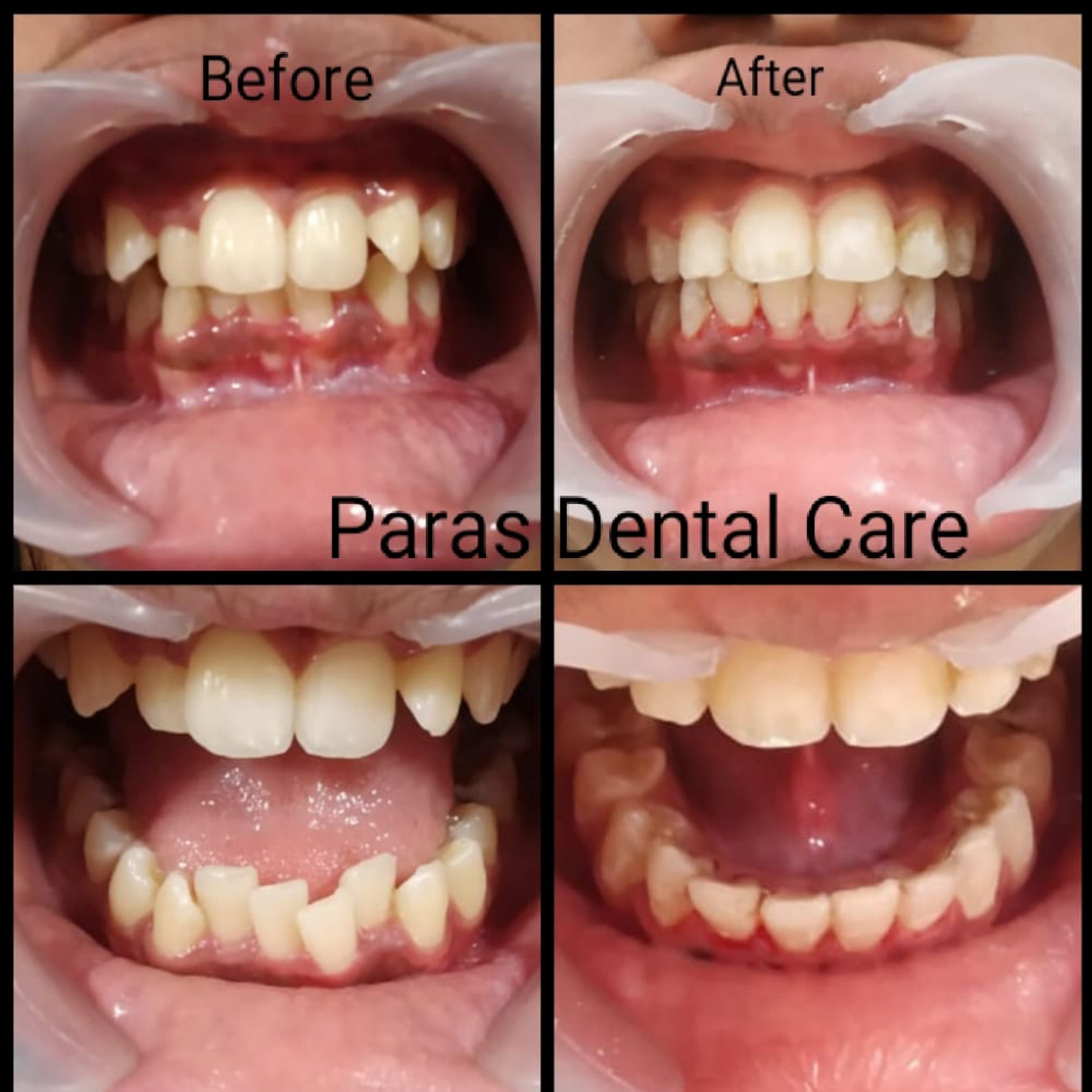 Not all crowding cases require extractions of h... main image