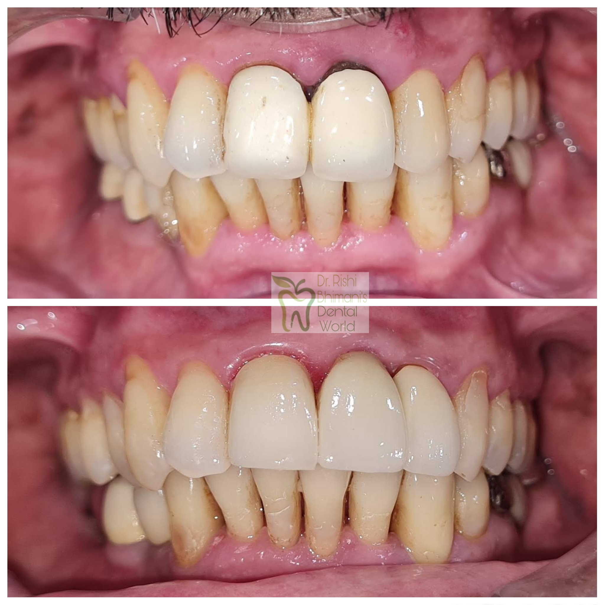 DENTAL IMPLANTS can replace one, few or all MIS... main image