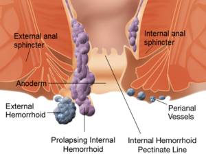 External hemorrhoids

These are under the skin ... main image