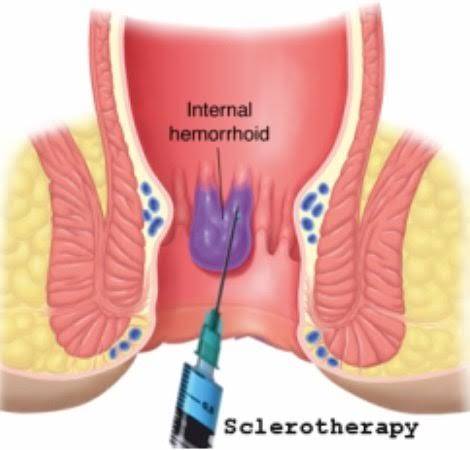 Internal hemorrhoids
Internal hemorrhoids lie ... main image