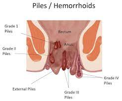 Piles Hospital in Gadchiroli . Piles doctor in ... main image