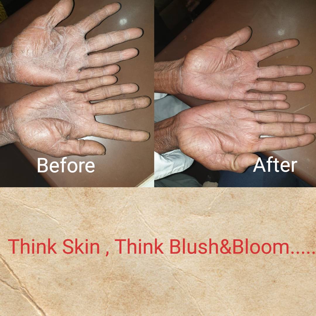 Eczema / ખરજવું 
Eczema is dryness and thickeni... main image