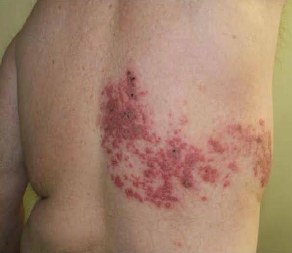 Herpes zoster
Herpes zoster occurs once in a lifet... main image