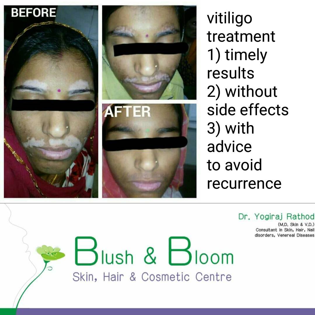 Vitiligo / કોઢ/ સફેદ દાગ
Vitiligo is an autoimmun... main image