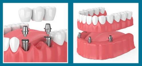There are situations when losing a tooth is ine... main image