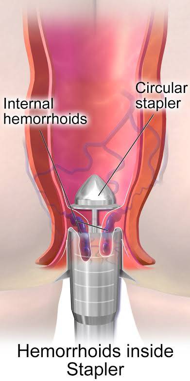 Surgical Procedures for Piles
Only a small per... main image
