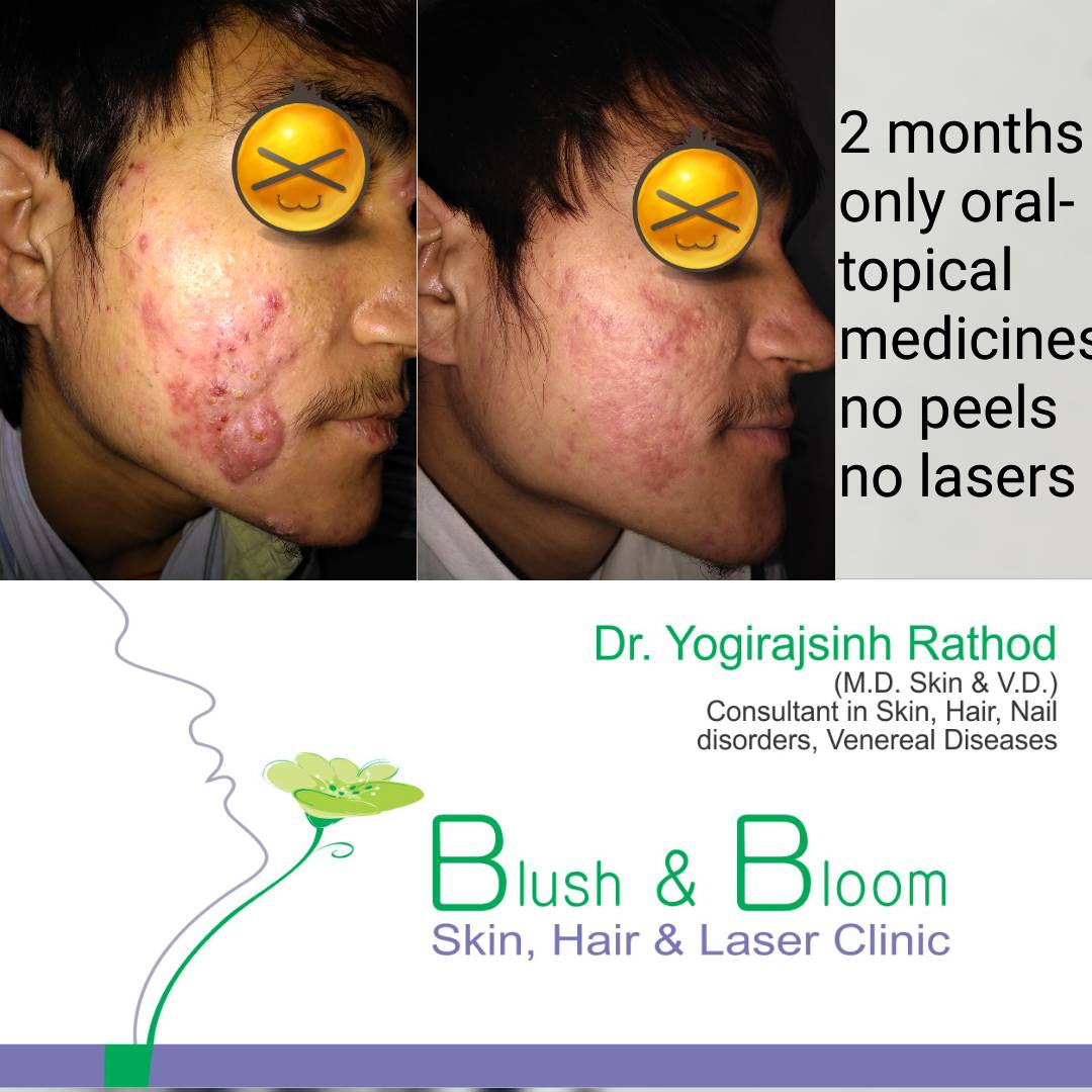 Acne / pimples / ખીલ 
Myths vs Facts
Myth- ther... main image