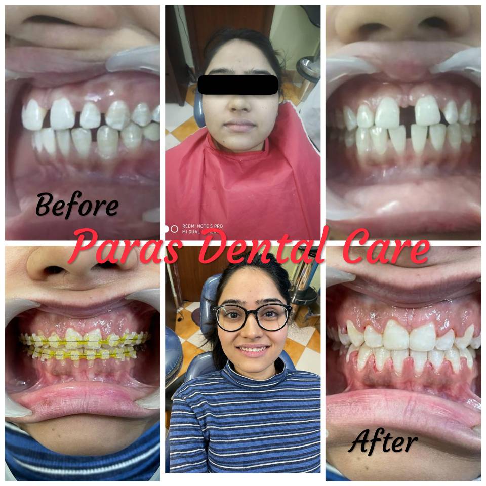 If you want to correct spacing between front teeth... main image