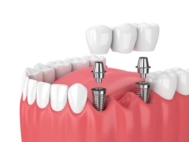 Full set of teethll always enhance the smile an... main image