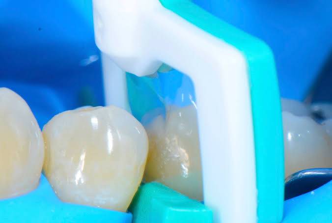 When you have a cavity or decay in your tooth a... main image