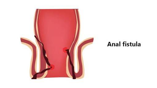 Fistula(Bhagandar) Symptoms:-

Foul smell from ... main image