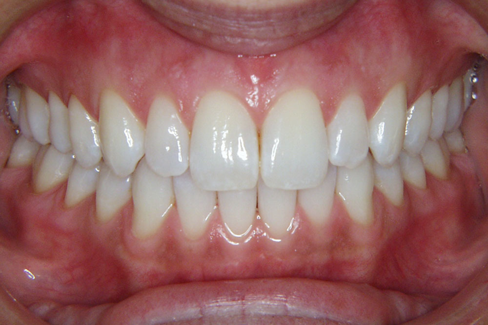 Can my tooth stay for life?
Yes, tooth can stay fo... main image