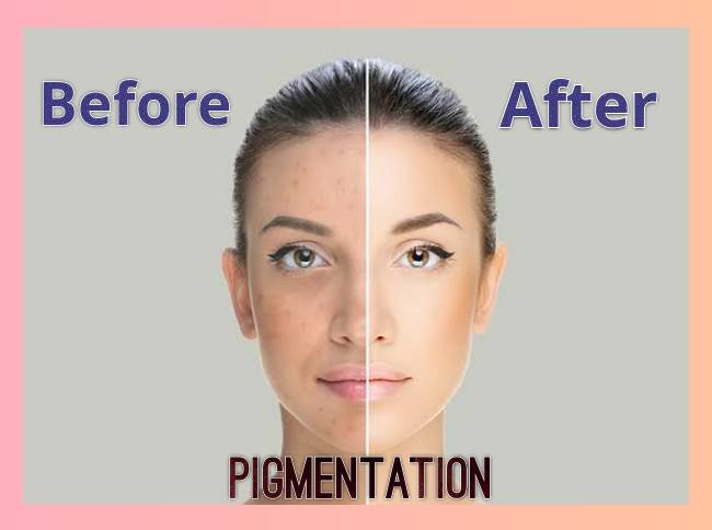 Get your pigment free skin clear with our New A... main image