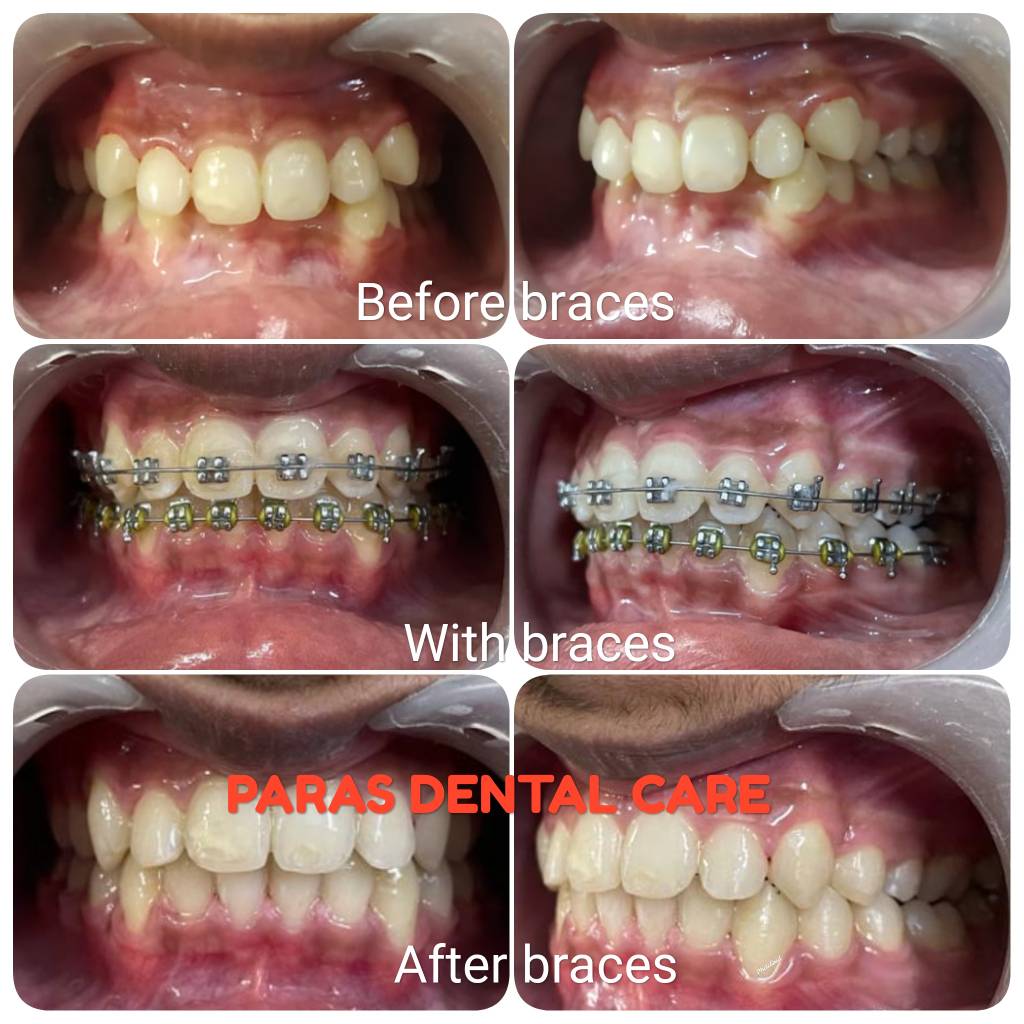 Case treated with metal braces and finished jus... main image