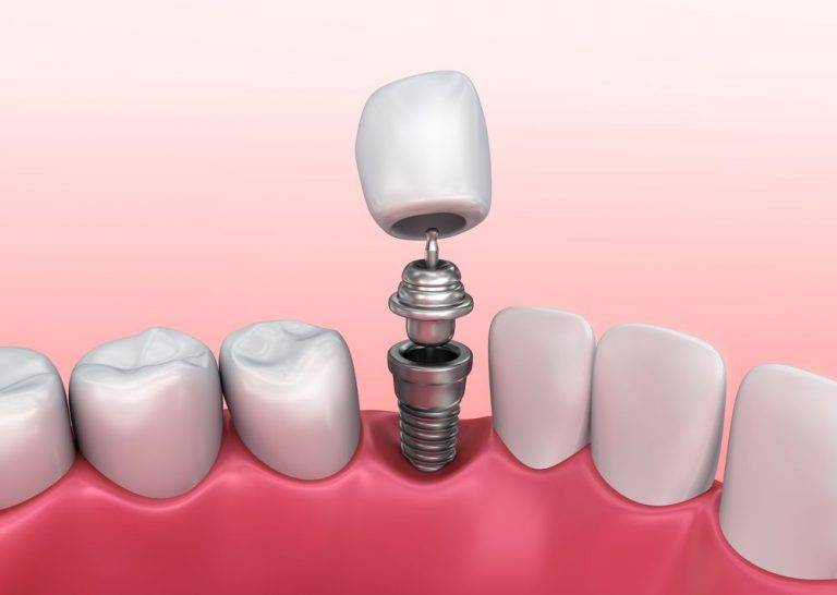 Dental implants are a very reliable and a perma... main image