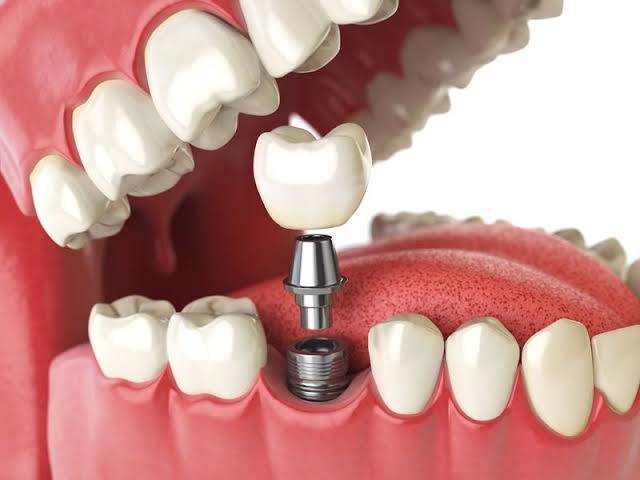 If you have experienced tooth loss, the best wa... main image