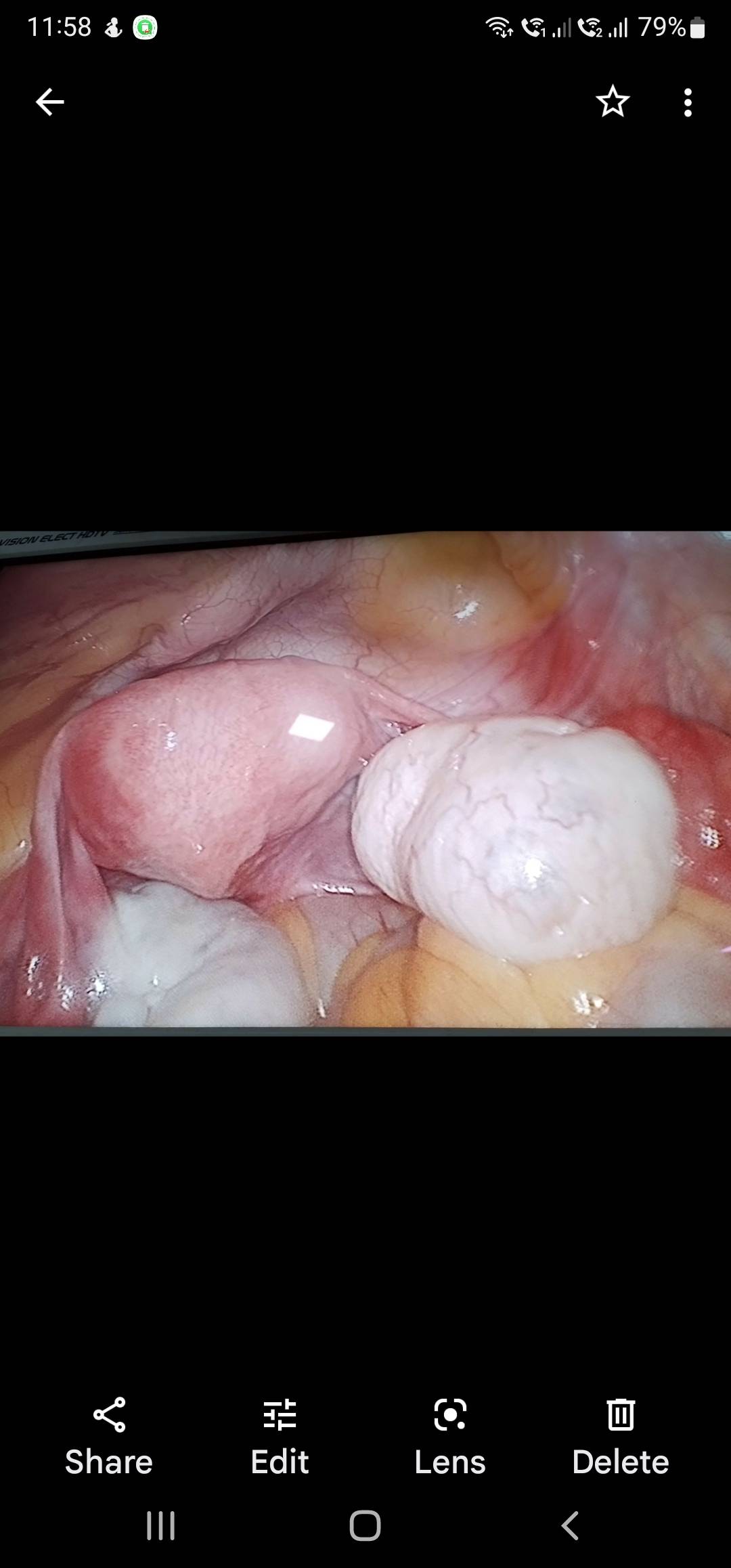 Laparoscopy (Keyhole surgery) is the mainstay o... main image