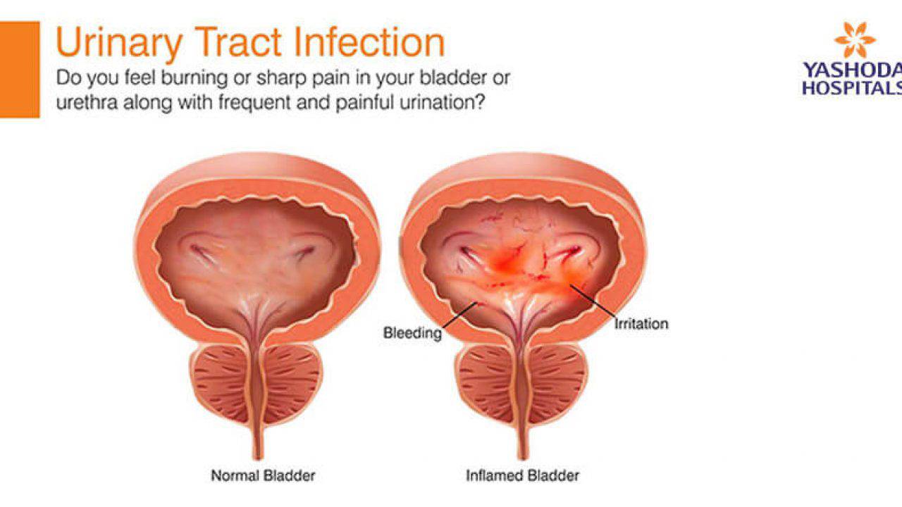 A burning sensation with urination can be caused by infectious
