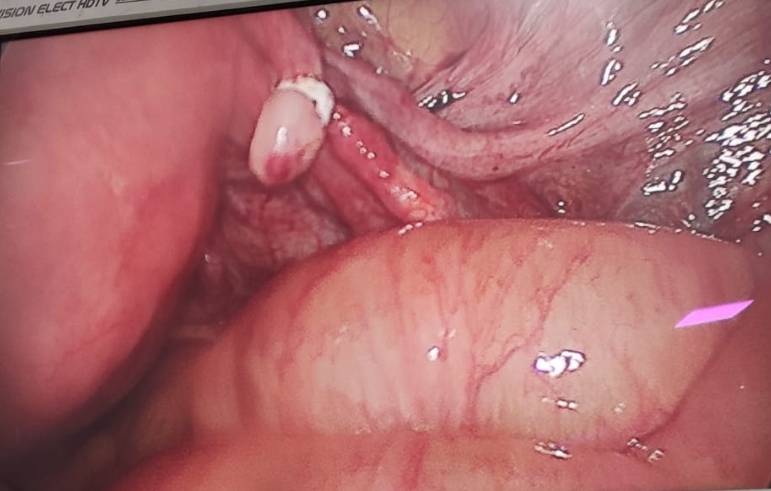 Laparoscopic tubectomy (दुर्बिणीद्वारे नसबंदी श... main image