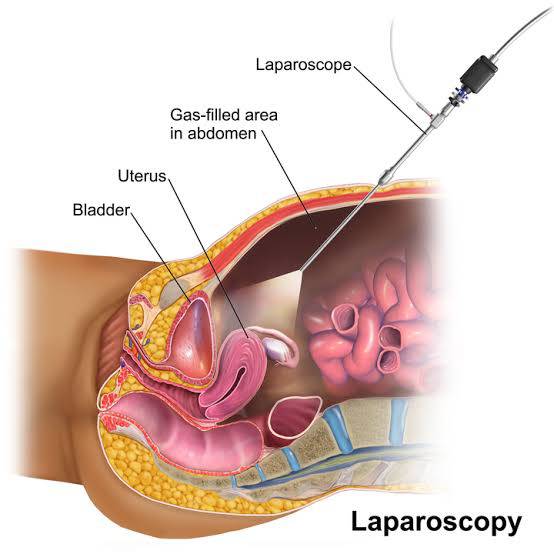 'LAPAROSCOPY'
लॅप्रोस्कोपीक शस्त्रक्रिया म्हणजे दु... main image
