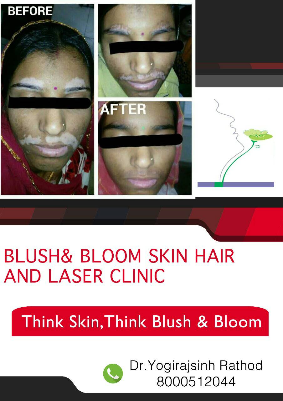 Vitiligo is curable.....
Think_Skin_Think_Blush_& ... main image