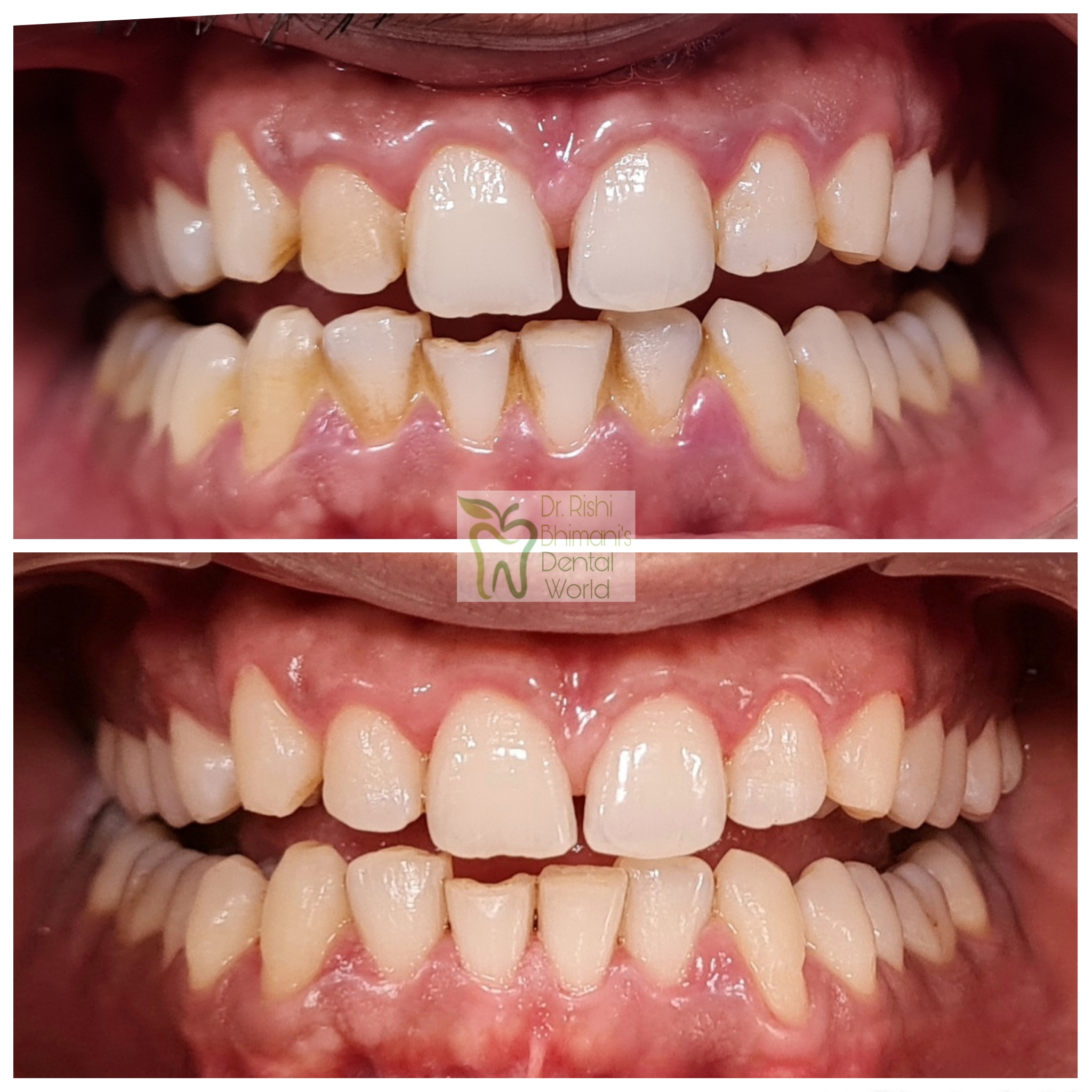 SCALING & amp; POLISHING or TEETH CLEANING is a... main image