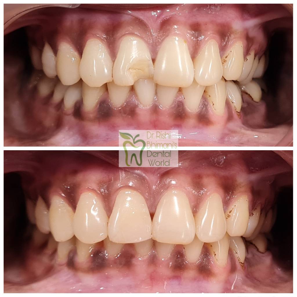 Front Teeth may chip or fracture due to traumat... main image