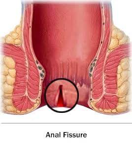 Prevention of fissure:-

Preventing constipatio... main image
