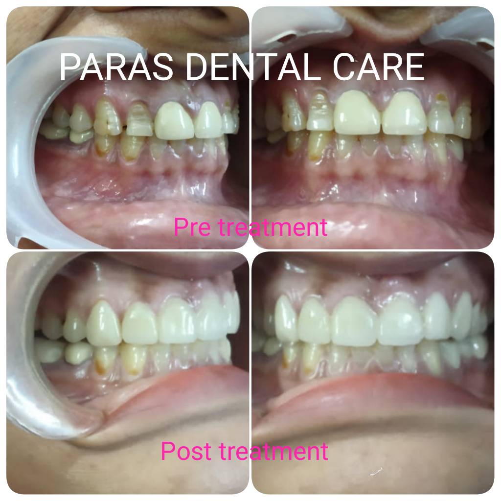 Worn, cracked or damaged teeth can be restored ... main image