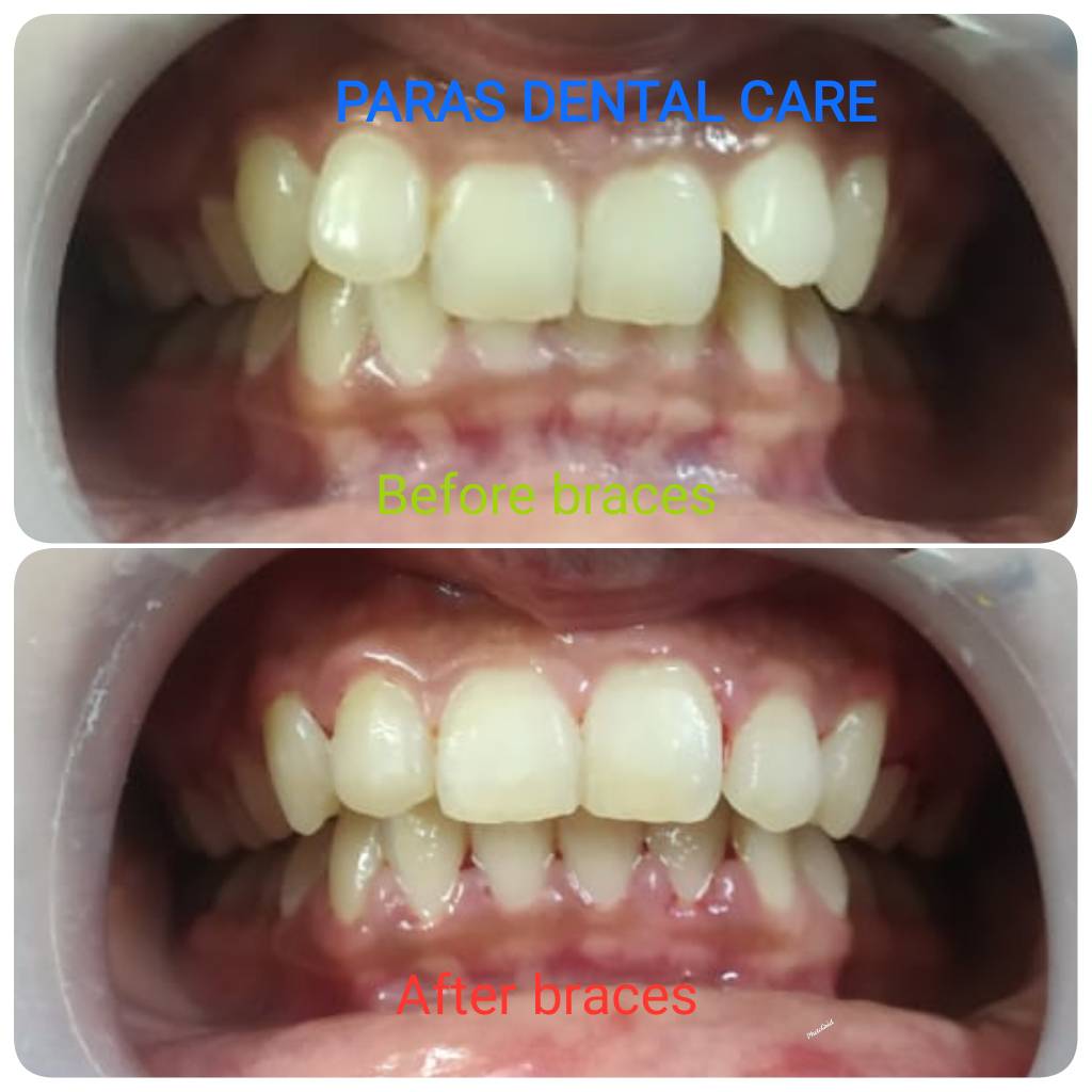 Short orthodontic case finished in just 5 months w... main image