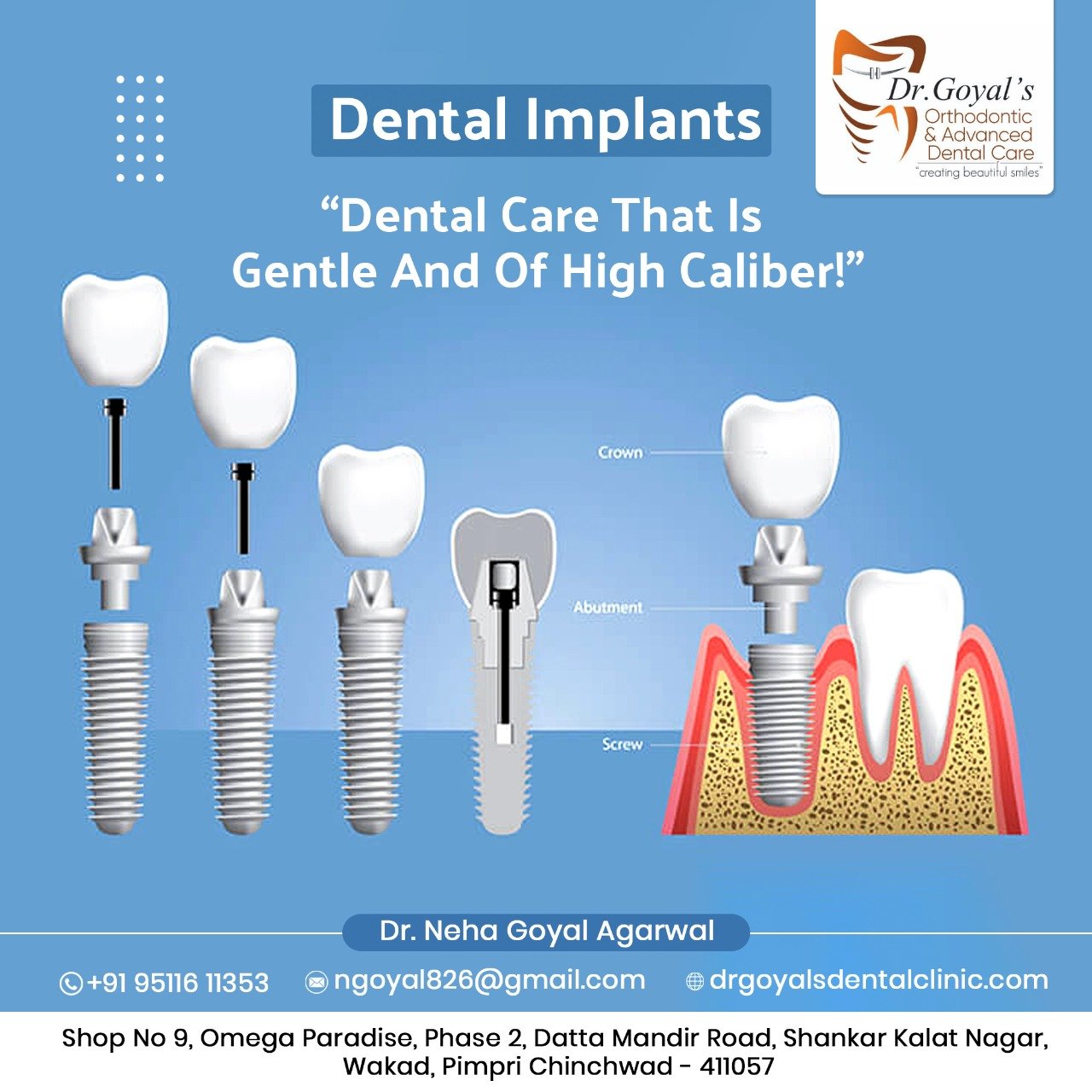 A dental implant is a long-term solution for to... main image