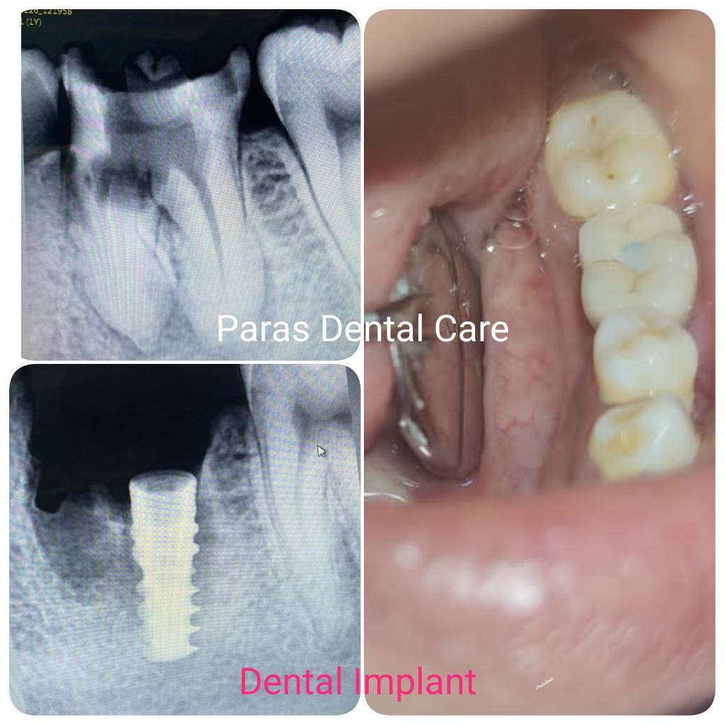 When it comes to replacing teeth that are missi... main image