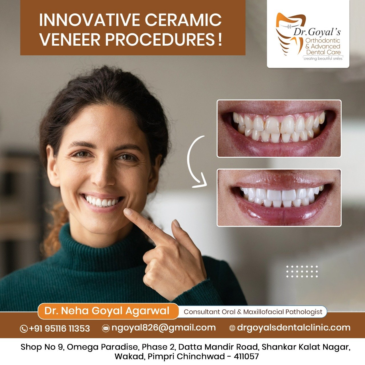 At our clinic, we provide a range of ceramic venee... main image