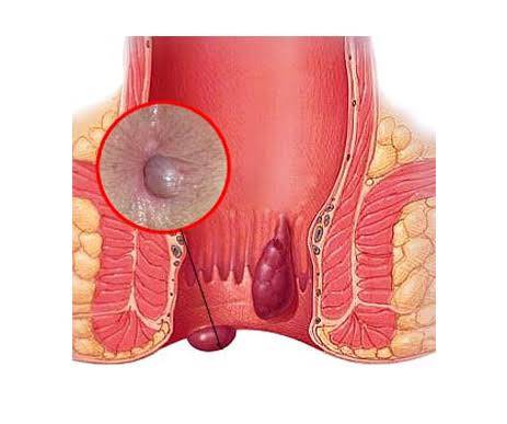 Causes of Piles:-
Piles result from increased p... main image