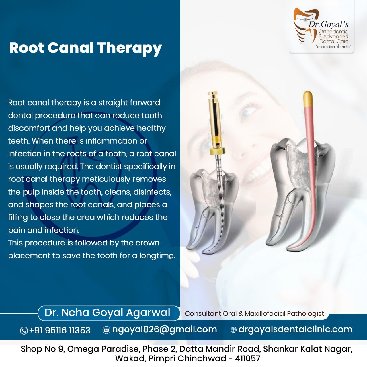 Root canal therapy is a straightforward dental ... main image