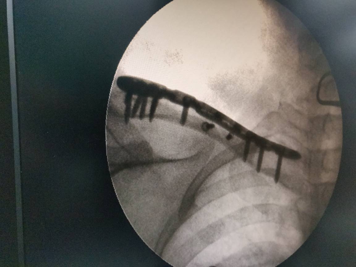 Best orthopedic surgeon in Aundh
Clavicle fractur... main image