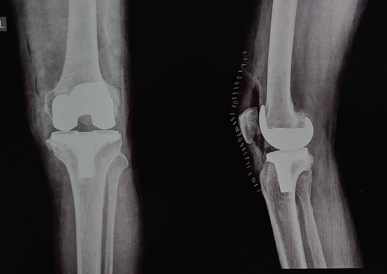 Knee replacement surgery is best treatment for ... main image