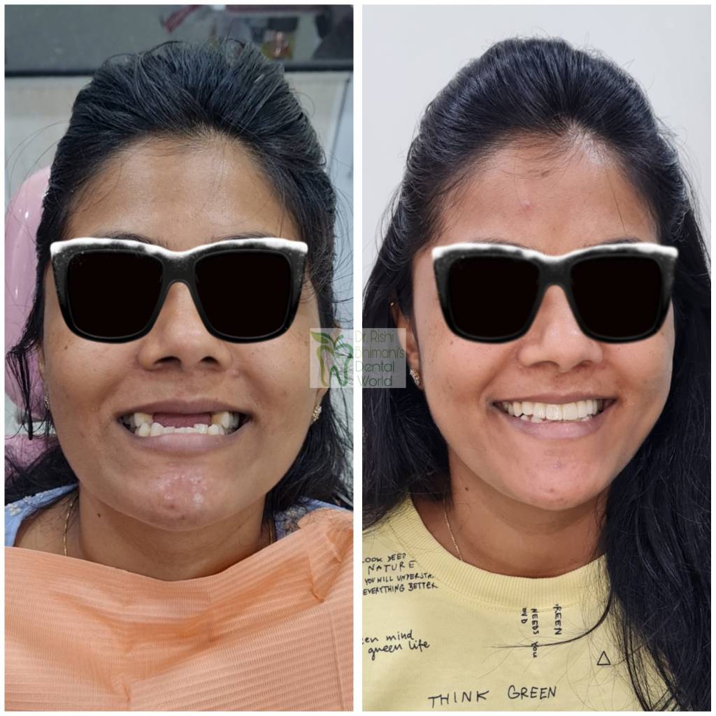 Smile Makeover for missing teeth can be done at... main image