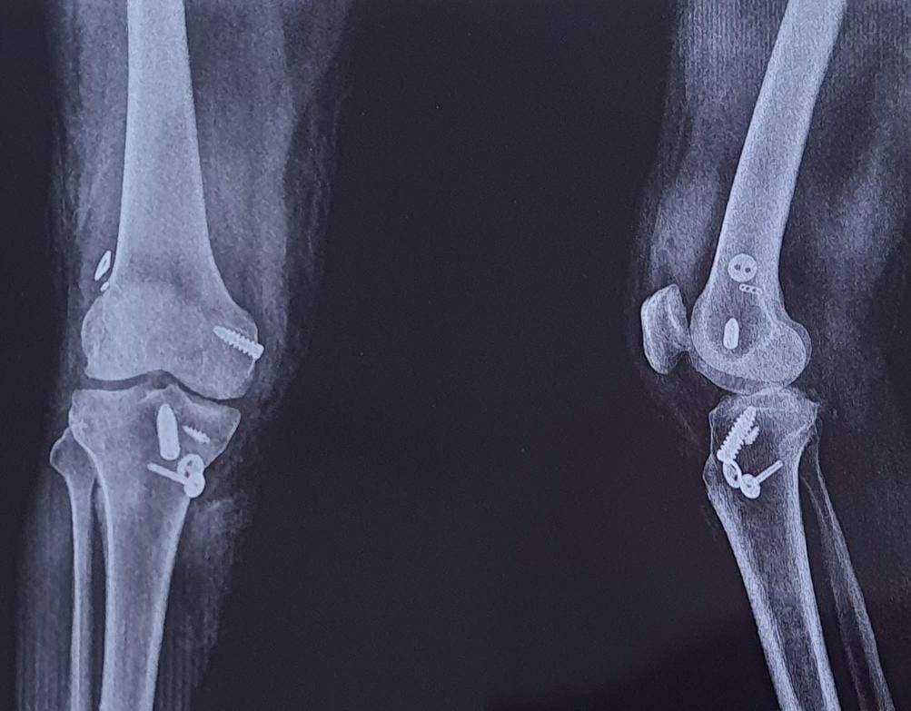 Best orthopedic center in Aundh. Multi ligament k... main image