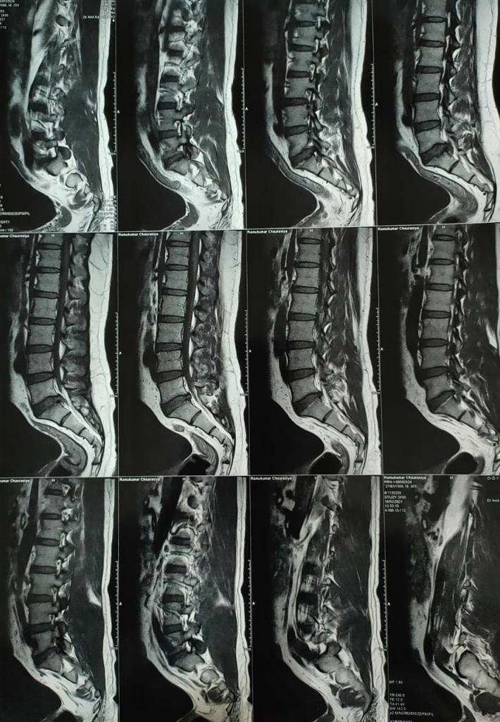 Prolapsed intervertebral disc is very disabling... main image