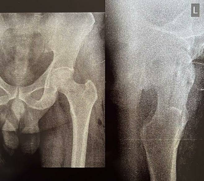 BMAC therapy for Avascular necrosis of hip join... main image