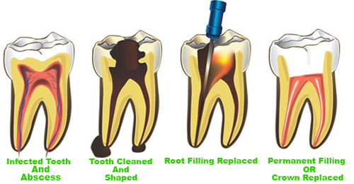 Do you want to consult Root Canal Treatment Doc... main image