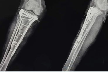 Best orthopedic center . Multi ligament knee injur... main image