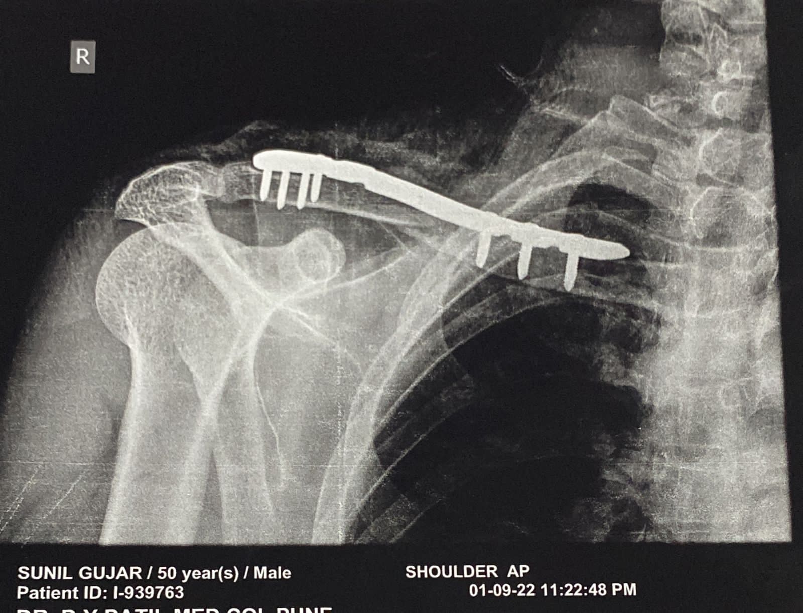 Total hip replacement
It is treatment of choice... main image