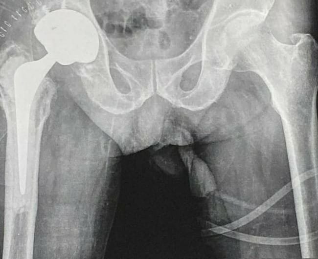 Total hip replacement
It is treatment of choice... main image