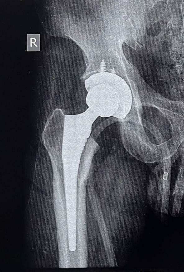 Total hip replacement
It is treatment of choice... main image