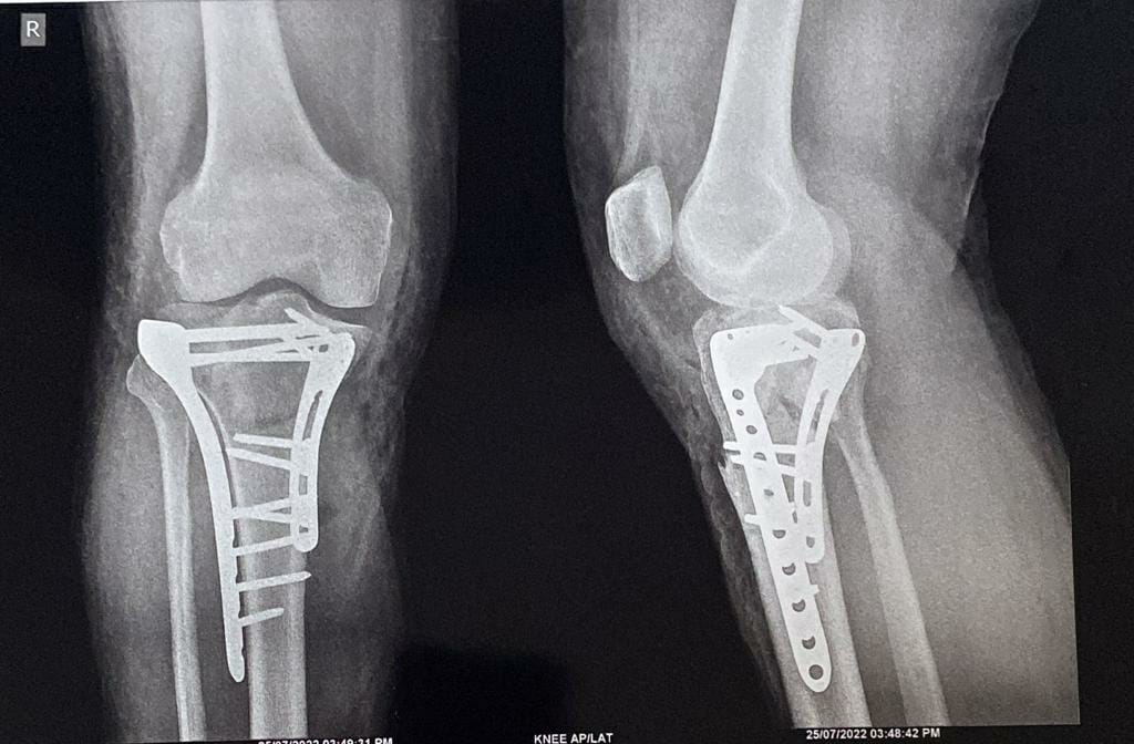 Total hip replacement
It is treatment of choice... main image