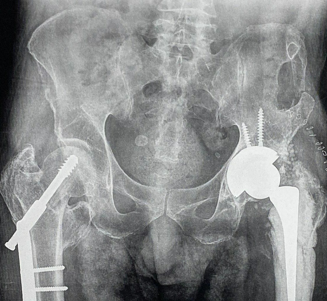 Total hip replacement
It is treatment of choice... main image